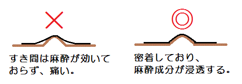 麻酔テープを貼るコツ